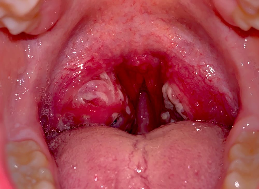 Get Rid of Tonsil Stones